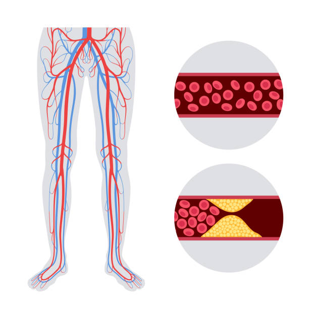 Le syndrome des jambes sans repos