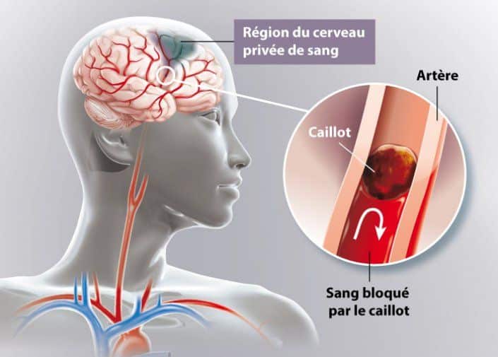 Un soutien après un AVC